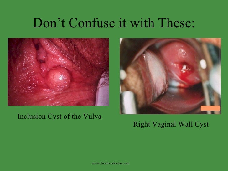 Cysts of the vagina