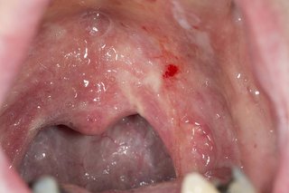 Thrush in cause oral adults what