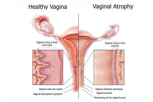 How to cure a dry vagina