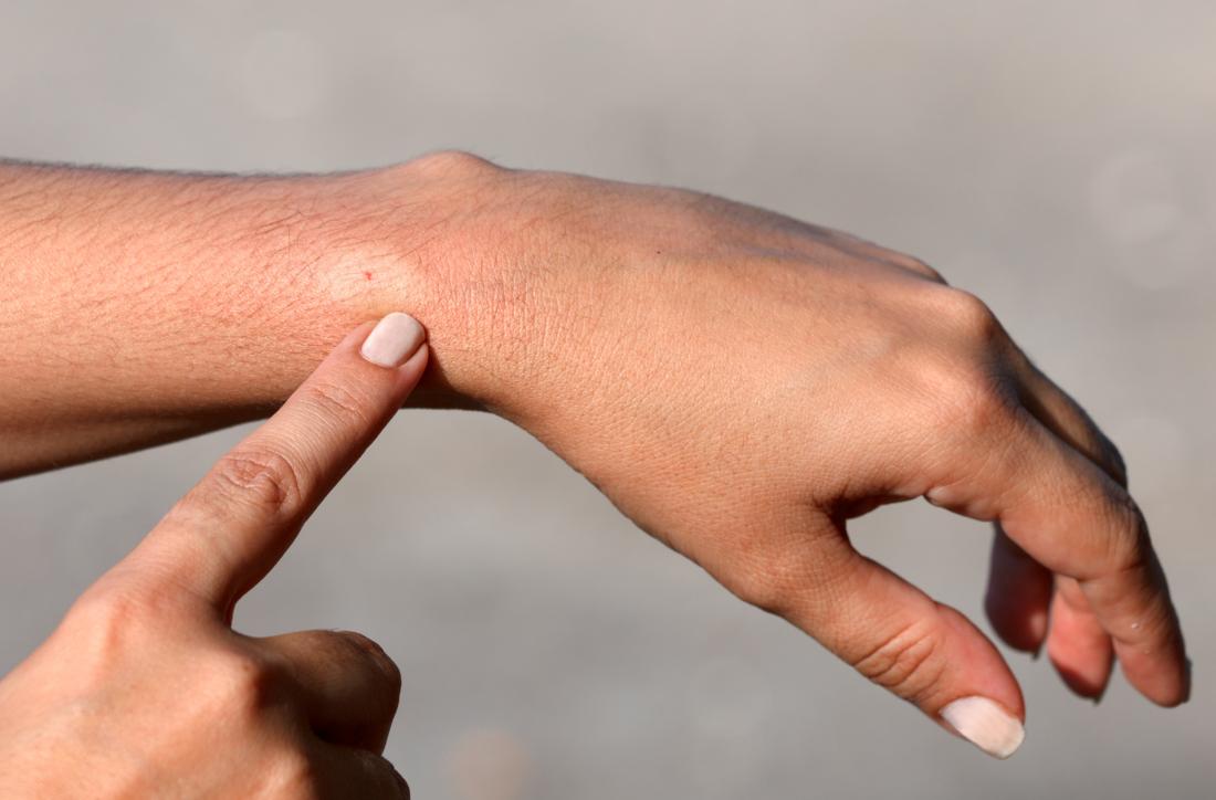 Bee sting reactions in adults