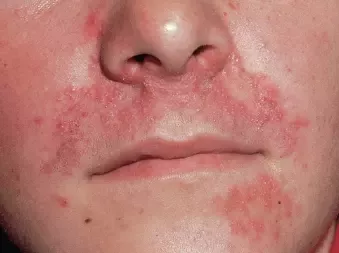 What is facial hives