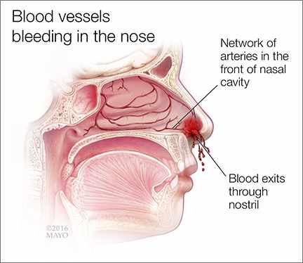 Cause for nose bleeds in adults