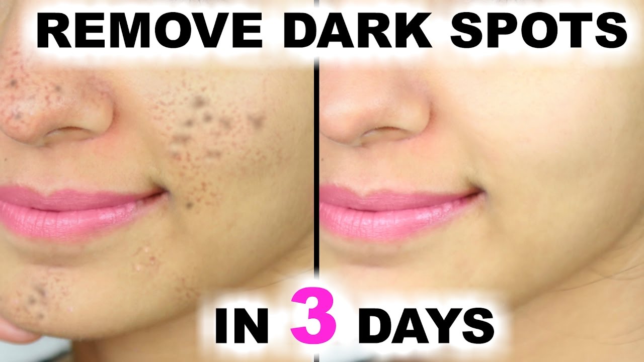 Removing facial brown spots