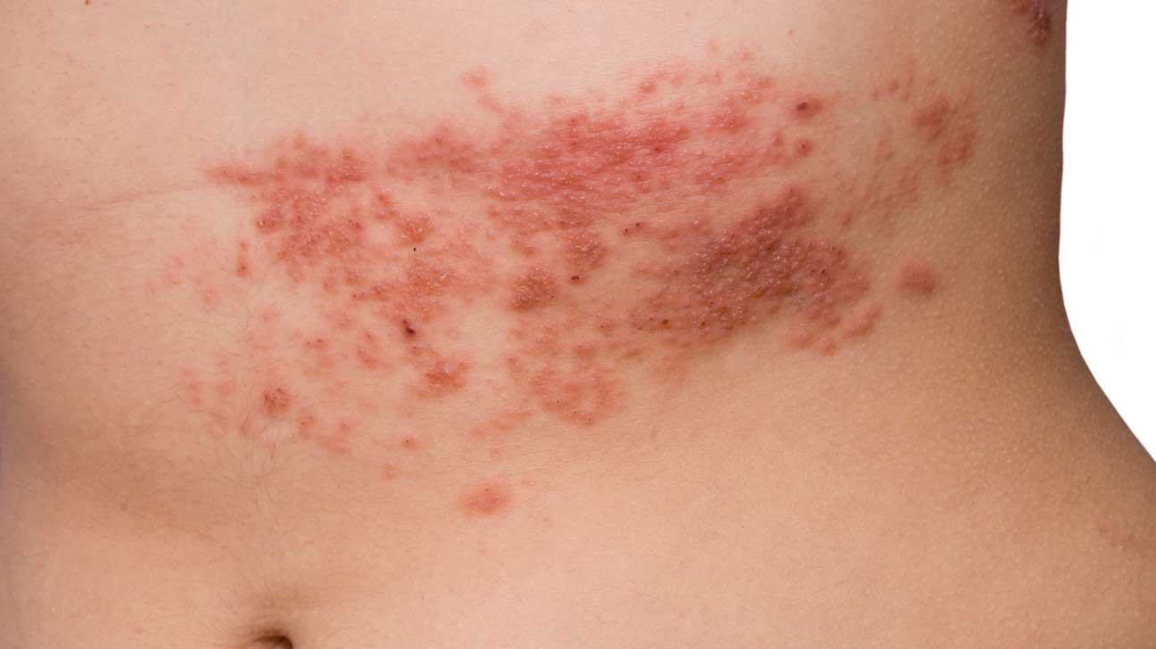 Identify a rash in adults