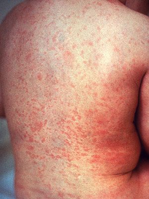 Identify a rash in adults