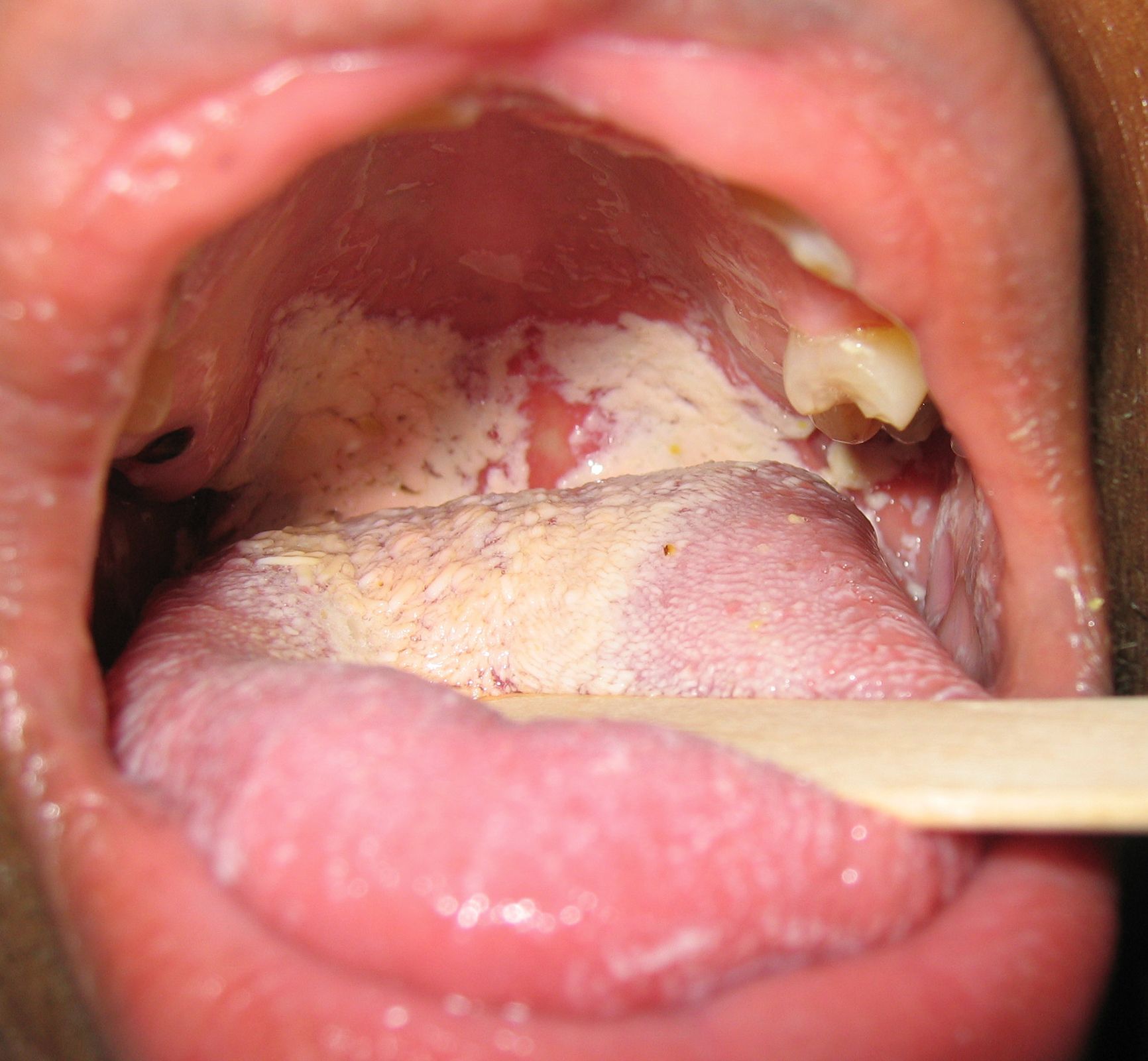 Thrush in cause oral adults what