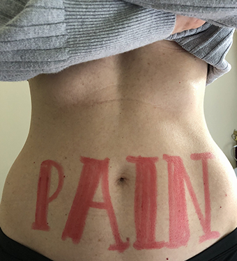 Pain after sex polycystic