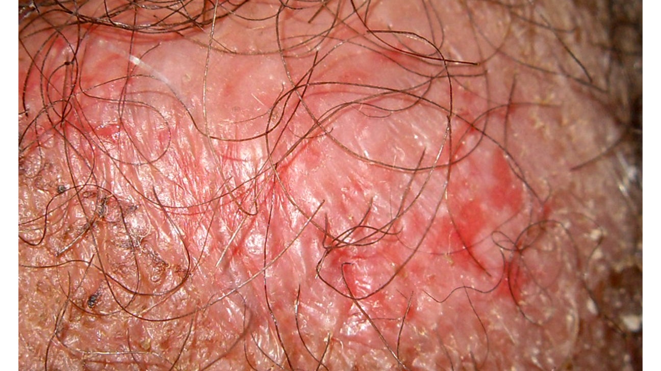 Dry skin on penis head